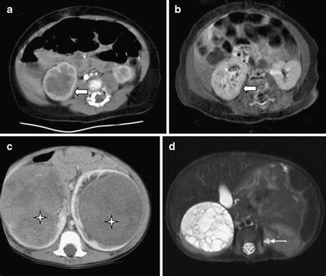 Renal Tumors Case 1 Mesoblastic Nephroma Axial Cect A And