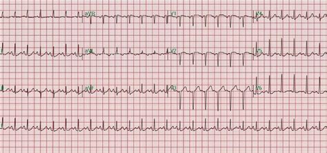 Cardiorespiratory Failure In Thyroid Storm Case Report And Literature