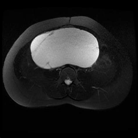 Ovarian Serous Cystadenoma Radiology Reference Article