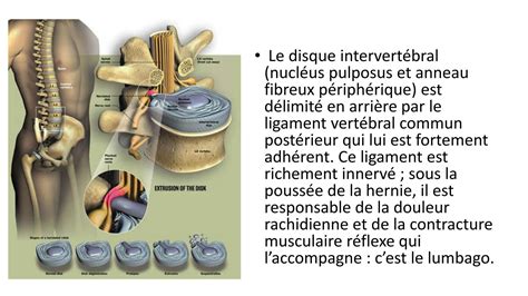 Solution Hernie Discale Lombaire Et Canal Lombaire Troit D G N Ratif