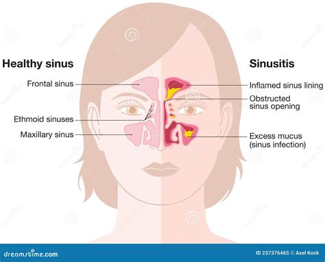 Healthy Sinus And Sinusitis Medical Illustration Stock Illustration