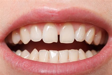 Ways To Fix Gap In Front Teeth Smile Angels Of Beverly Hills