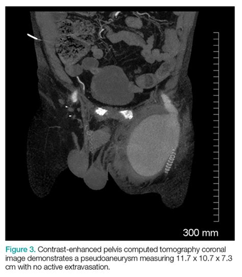 Emergency Imaging Femoral Pseudoaneurysm Mdedge Emergency Medicine