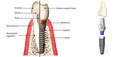 Dental Implant Process Cdglanden