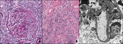 A Light Microscopy Of Kidney Biopsy Showing Crescent Formation In The