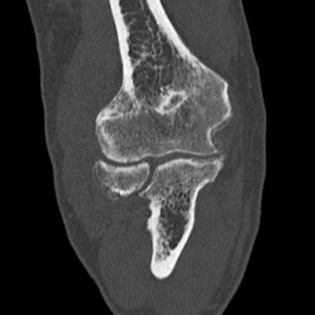 Osteoarthritis Of The Elbow Image Radiopaedia Org