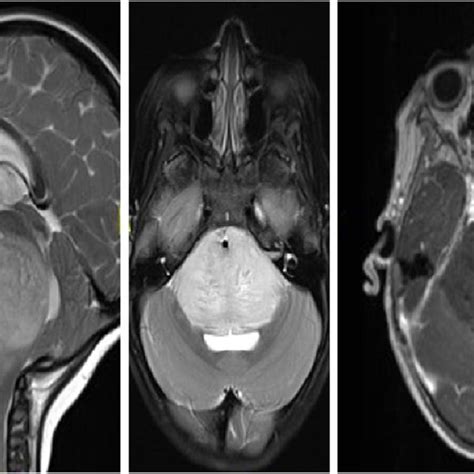 Tectal plate glioma (TPG): axial FLAIR, and sagittal T2-weighted and... | Download Scientific ...