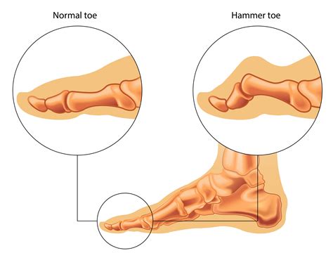 Hammer Toes: Throw the kitchen sink at them | Foot Problems?