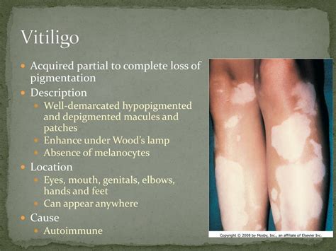 Ppt Disorders Of Pigmentation Powerpoint Presentation Id715908