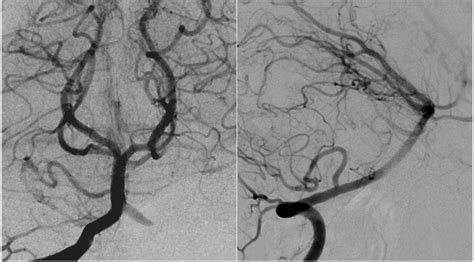 A B Cerebral Angiography Of The Vertebrobasilar Circulation Right