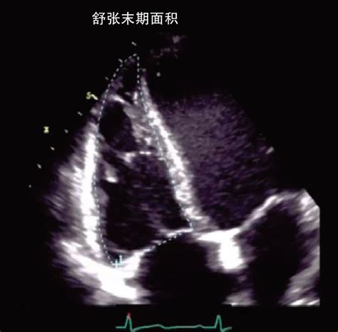 秒懂超声心动图的测量方法 好医术文章 好医术 赋能医生守护生命