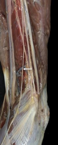 Medial Antebrachial Cutaneous Nerve Mabcn Martinoli Ultrasound