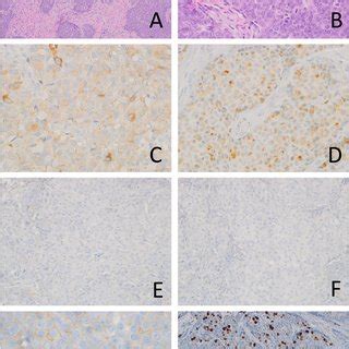 Morphological And Immunohistochemical Features Of B NET At Low Power