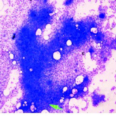 Bone Marrow Aspiration Smear Showing Increased Megakaryocytes In Case