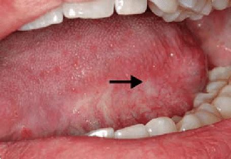 Known Cancer Patient Presenting With A Small Erosive Lesion On The Left