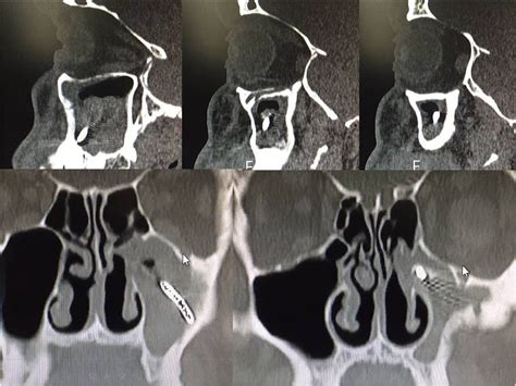 Sinus Computed Tomography CT Executed Without Contrast Evidenced The