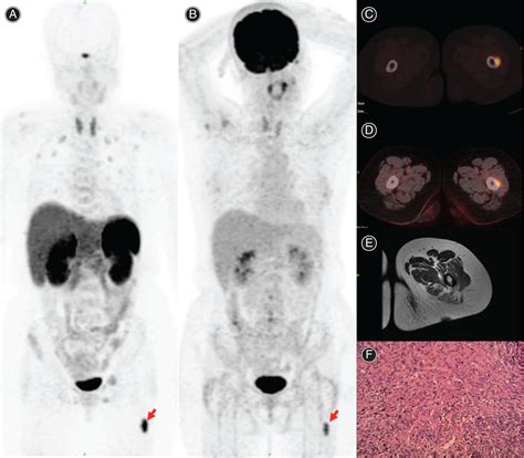 Comparison Of Ffdg Pet Ct And Gadotatate Pet Ct In The Targeted