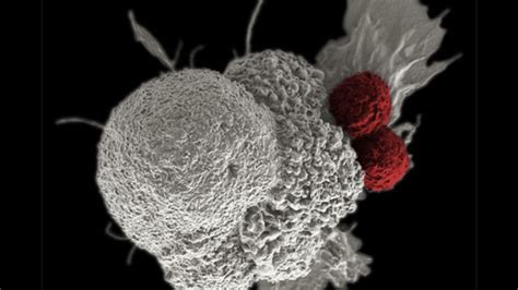 Immunotherapy Combination Helps Curb Growth of Metastatic Melanoma ...