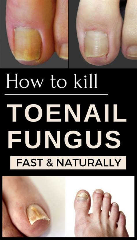 How To Get Rid Of Toenail Fungus Fast And Naturally