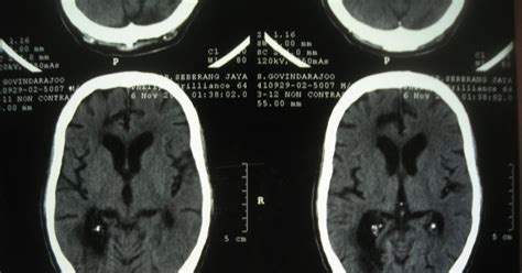 Medicine for MRCP & Medical Students: Wallenberg syndrome