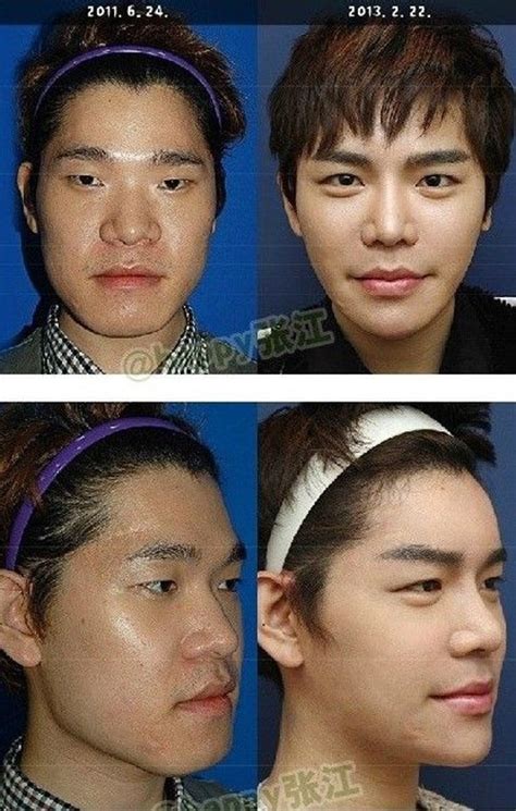 Ngỡ ngàng hình ảnh anh chàng xấu xí phẫu thuật thành hot boy