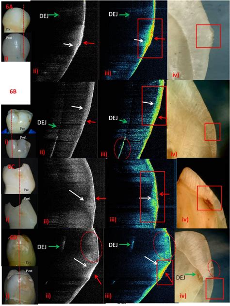 Post Remineralization Icdas Ii Score Using Nhp A I Score Ii