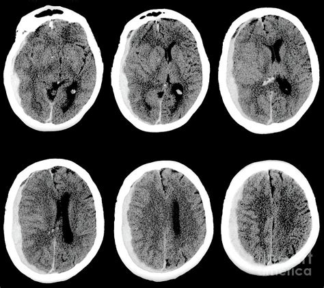 Subdural Hematoma Photograph By Zephyr Science Photo Library Pixels