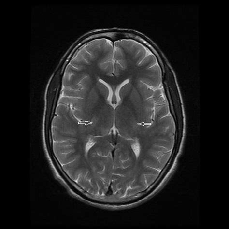 Axial Fast Spin Echo Fse Mri Showing Subtle Hyperintensities In