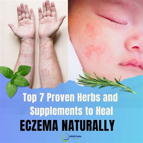 blog holistic eczema