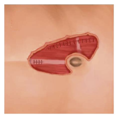 Schematic Diagram Of The Left Situs Incision A Patients Position