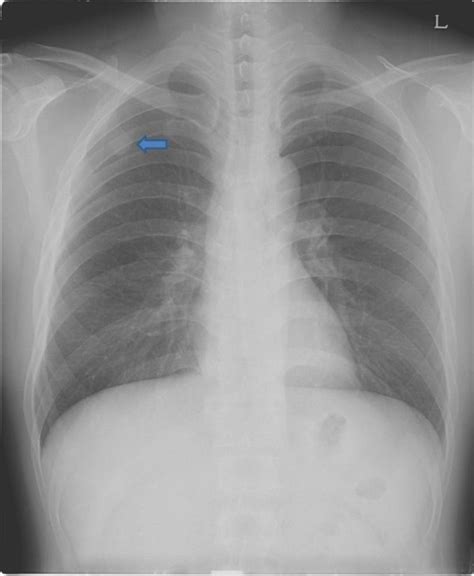 Preoperative Chest Radiograph PA View Shows A Round Opacity On The