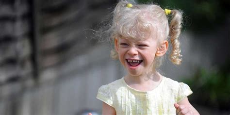 Williams Syndrome Causes Symptoms Diagnosis Treatment And