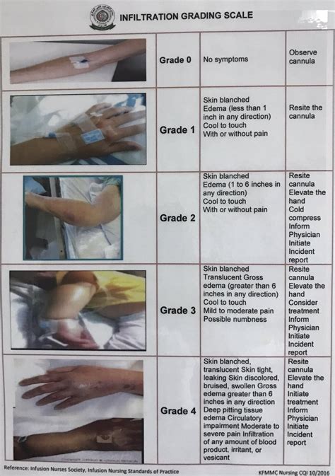 Infiltration Vs Phlebitis