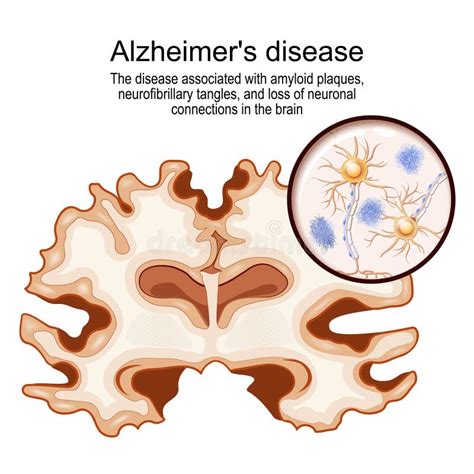 Enfermedad De Alzheimer Infographic Médico Ilustración Del Vector Ilustración De Neurona