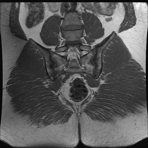 Ankylosing Spondylitis Image