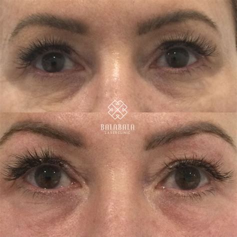 Fotona Smooth Eye Laser Treatment Adelaide BalaBala