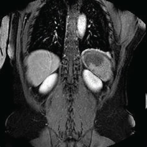 Abdominal Mri Axial T2 Weighted Image A Showing A High Intensity Download Scientific Diagram