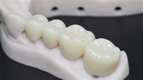 Types Of Dental Crowns And Materials Gold Porcelain Lithium