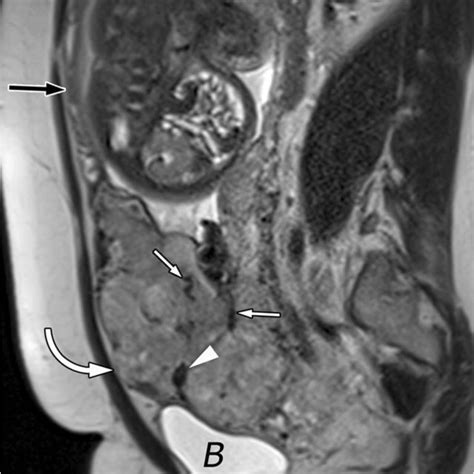 Placenta Percreta This Sagittal T2wi Shows Several Classic Signs Of