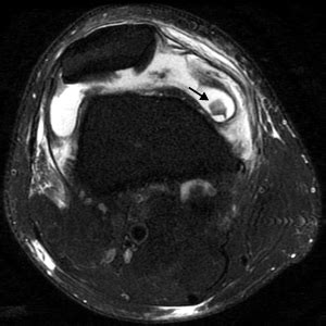 Radiologia Do Esporte Luxa O Lateral Da Patela Les O Ligamentar E