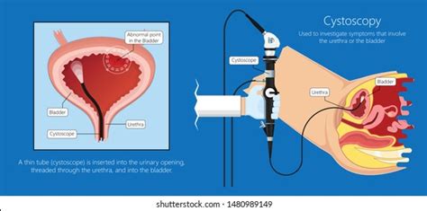 Cystoscopy - Tennessee Valley Urology Center