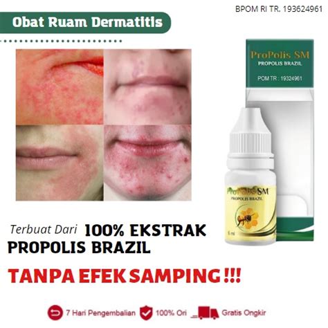 Jual Obat Ruam Dermatitis Perioral Benjolan Kecil Merah Di Sekitar