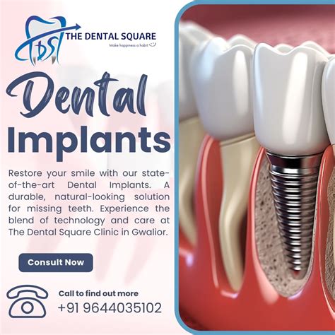 Dental Implants Procedure Importance And Types By Dr Sudhanshu Kushwah