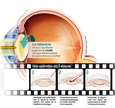 Les Progr S De La Chirurgie De La Cataracte