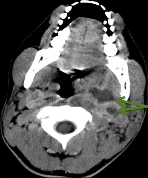 Ct Scan Of The Neck Demonstrating A Posterior Parapharyngeal