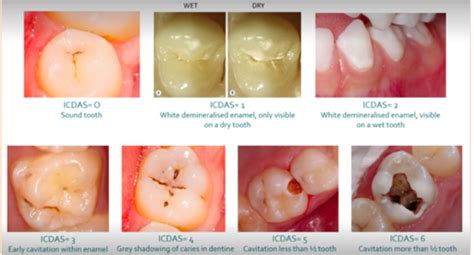 Diagnosis Of Dental Caries Flashcards Quizlet