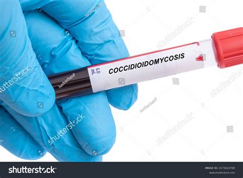 Coccidioidomycosis Coccidioidomycosis Disease Blood Test Doctor Stock