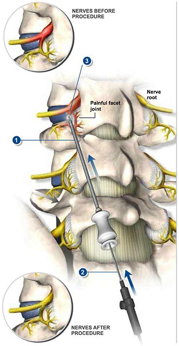 Rhizotomy