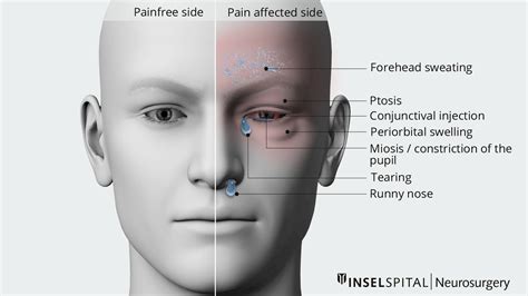 Cluster Headaches Neurosurgery Inselspital Bern