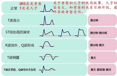 看完你也能看懂，趣說心電圖系列（四） 每日頭條